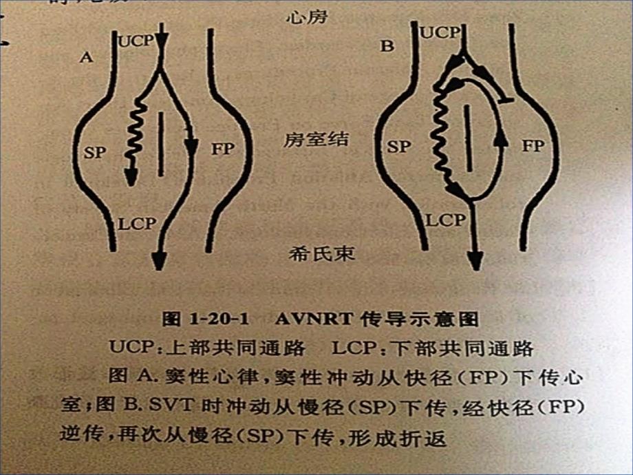 《阵发性室上性心动》PPT课件_第4页