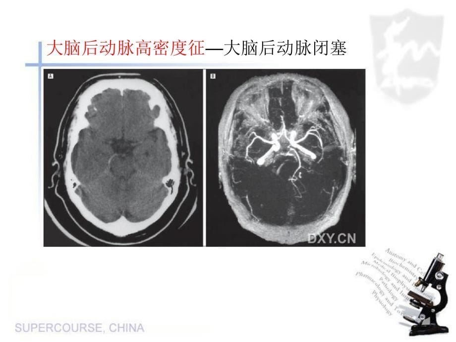 《特征性脑影像荟萃》PPT课件_第5页