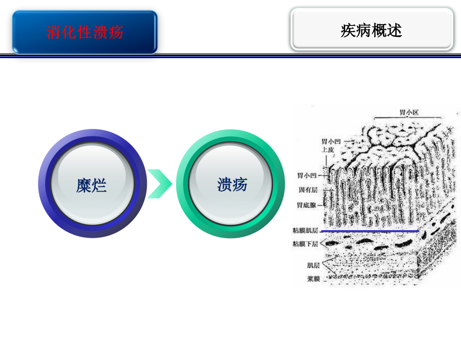 《消化性溃疡护校》PPT课件_第3页