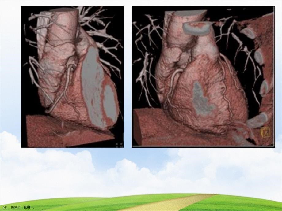 多排螺旋在冠脉的应用详解演示文稿_第5页