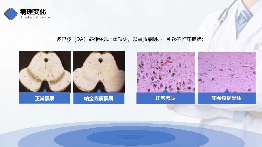 专题课件帕金森医疗病例介绍通用PPT模板_第4页