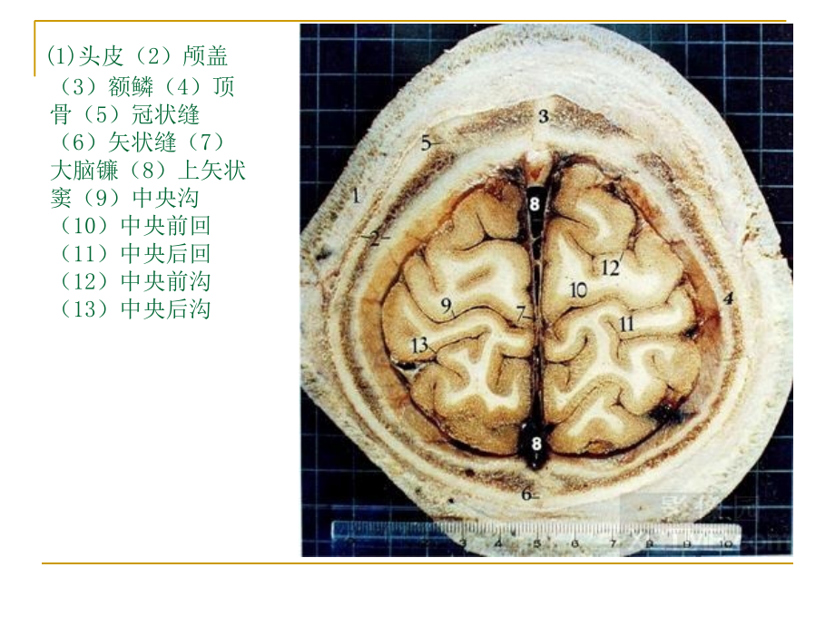 人体断层解剖图谱大脑课件_第3页