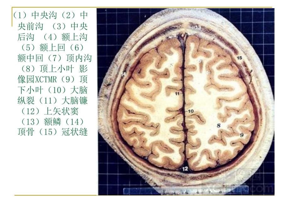 人体断层解剖图谱大脑课件_第5页