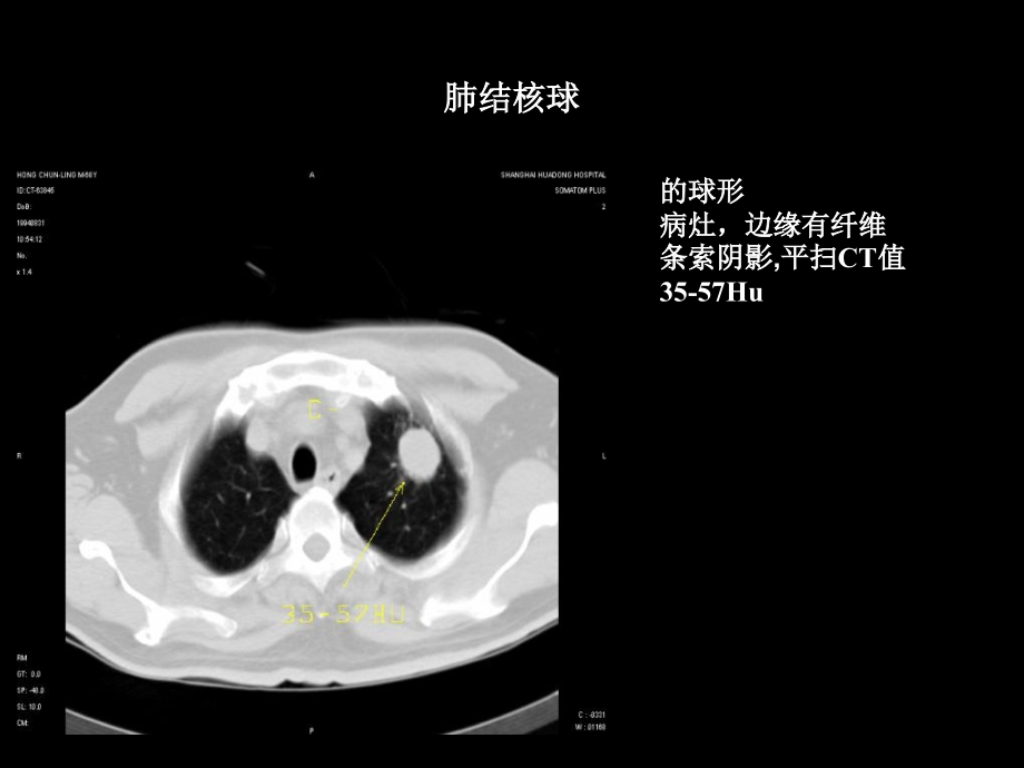 肺部疾病的CT鉴别诊断_第3页