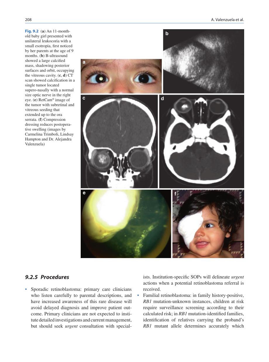 a language for retinoblastoma guidelines and standard operating procedures：一个视网膜母细胞瘤的指南和标准操作程序的语言_第4页