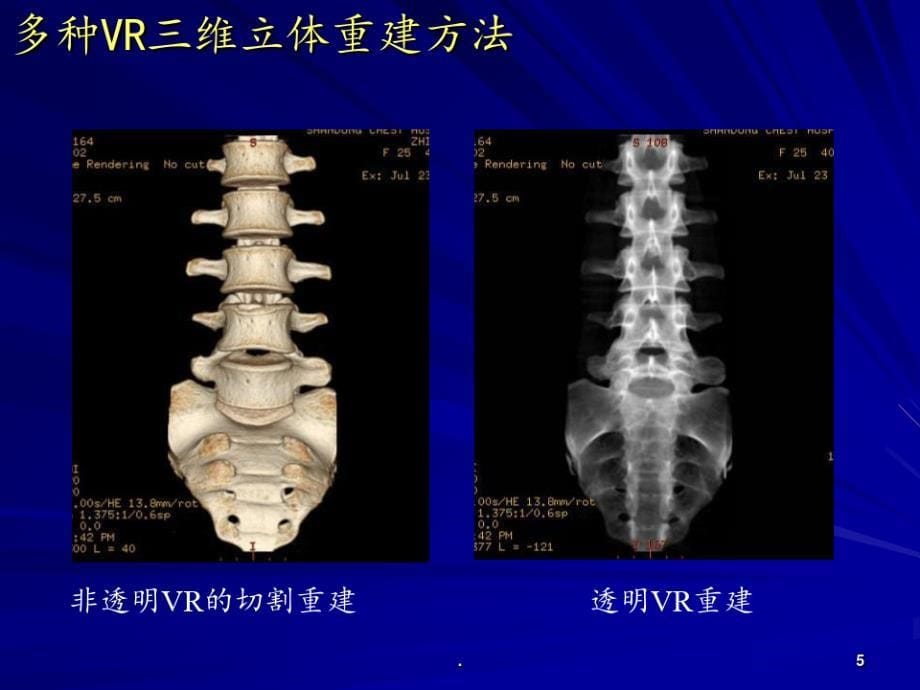 侯代伦骨关节结核影像学诊断PPT课件_第5页