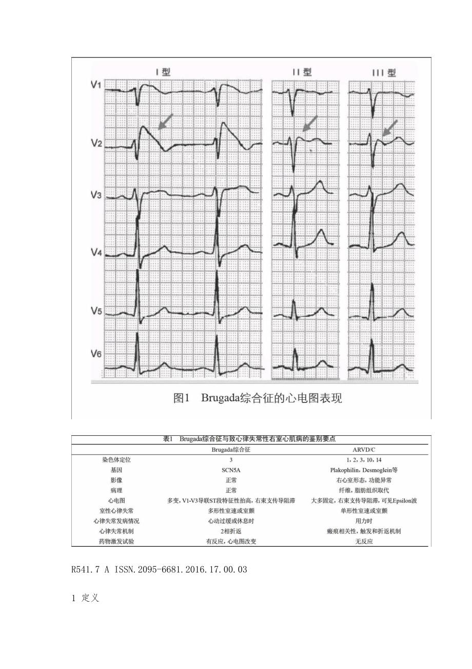 Brugada综合征的诊断及治疗_第2页