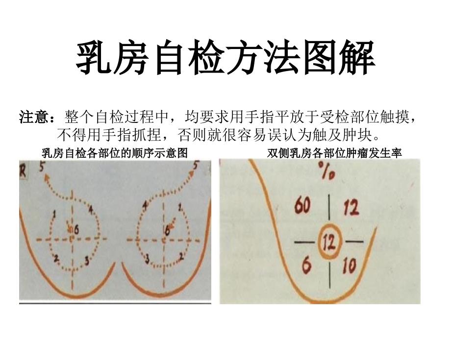 良性乳腺疾病与乳腺癌的相关性课件_第4页