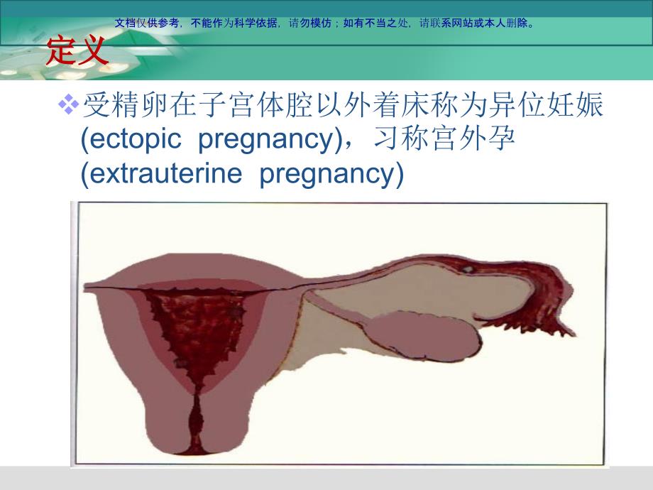 腹腔镜下宫外孕手术的医疗护理配合ppt课件_第1页