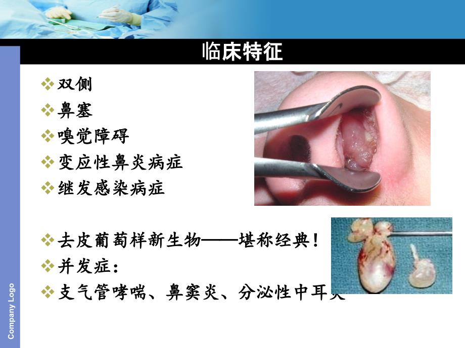 03鼻息肉 鼻窦炎_第4页