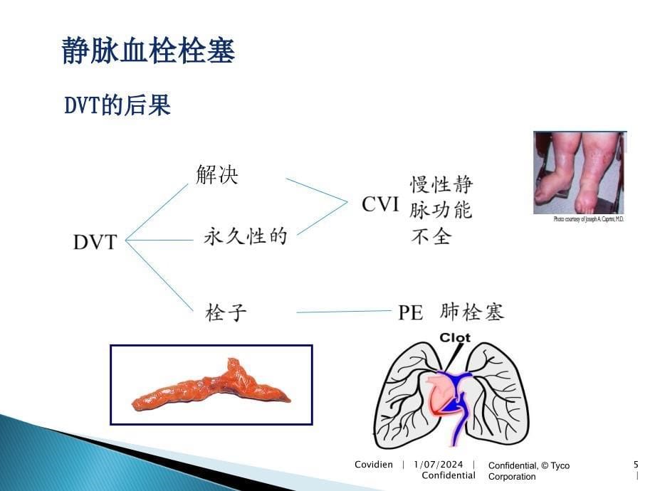 《静脉血栓栓塞》ppt课件_第5页