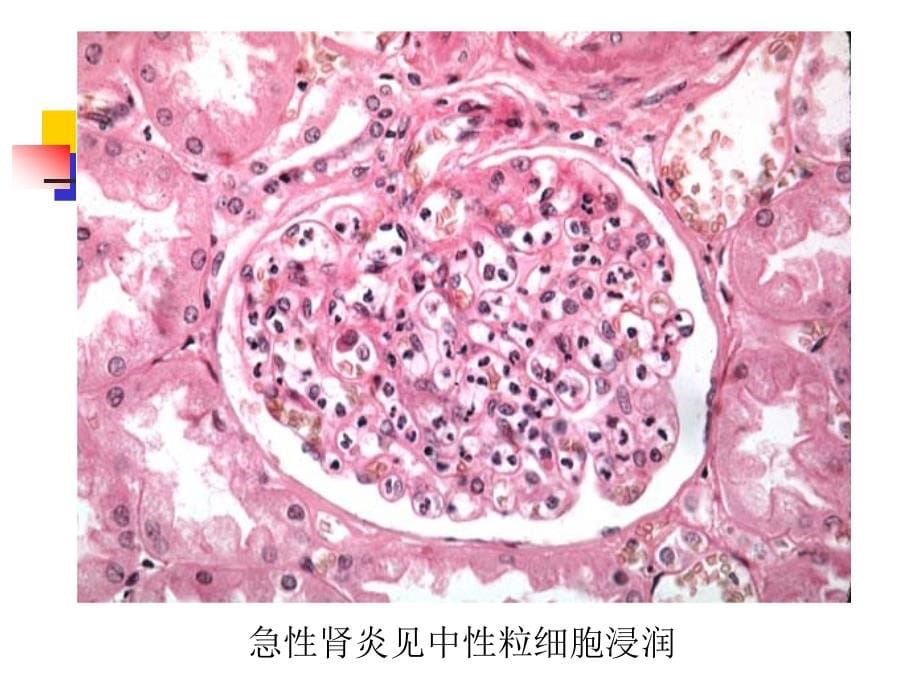 第五篇-第三章-肾小球肾炎课件_第5页