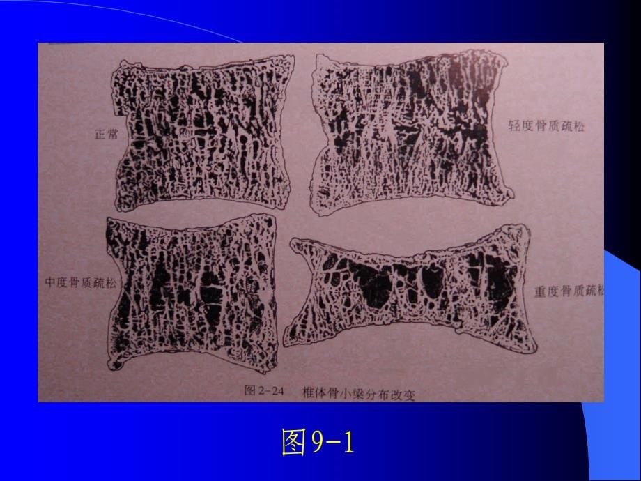 第九章老年人常见疾病与护理三四课件_第5页