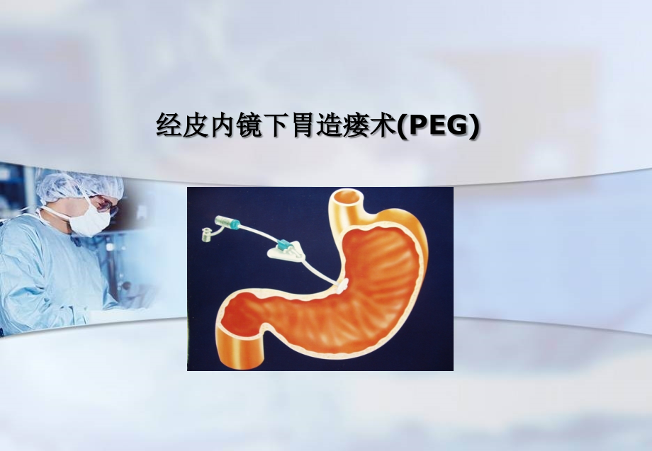 经皮内镜下胃造瘘术课件_第1页
