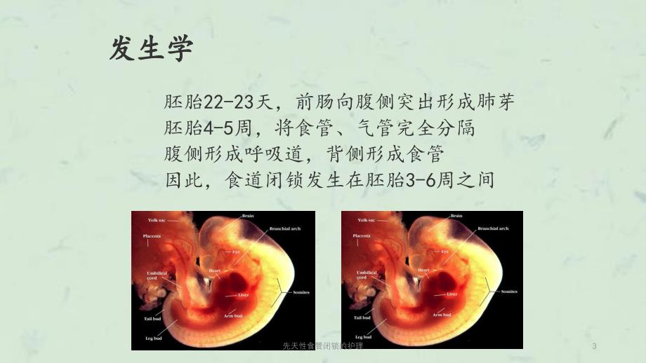 先天性食管闭锁的护理课件_第3页