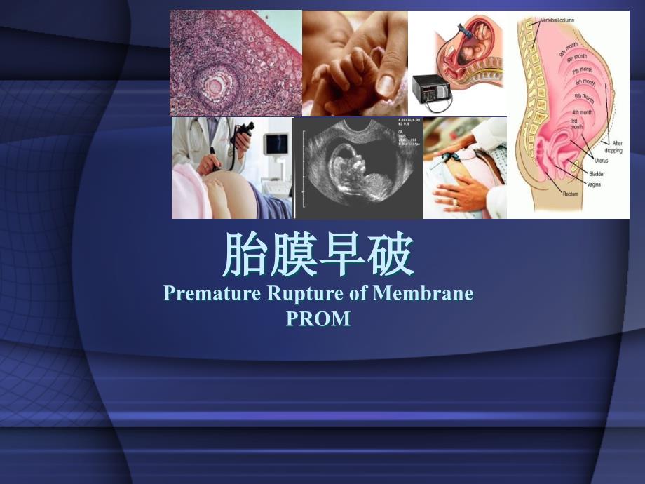 产科胎膜早破产科学课件讲义_第1页