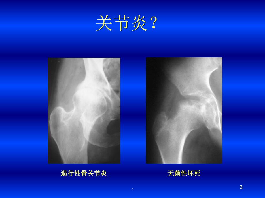 (医学课件)关节炎的影像学表现ppt演示课件_第3页