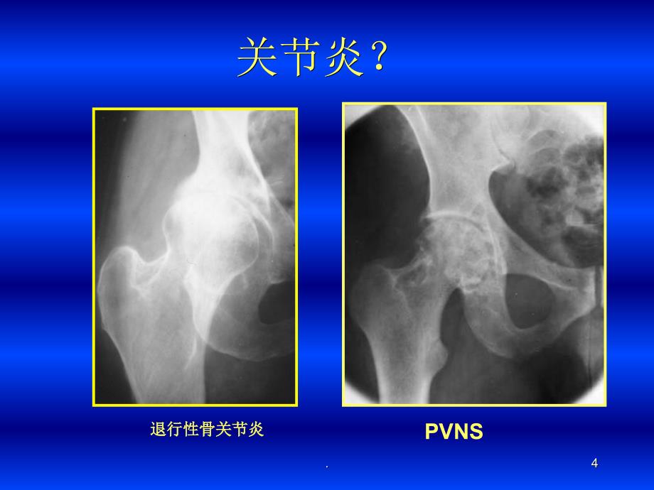 (医学课件)关节炎的影像学表现ppt演示课件_第4页