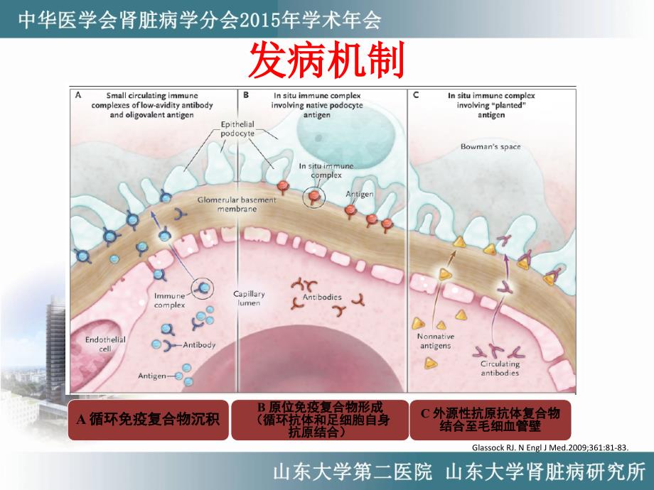 膜性肾病诊治进展LG.ppt_第4页