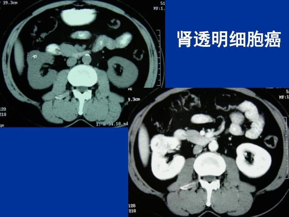 肾细胞癌的病理分类的变化.ppt_第5页