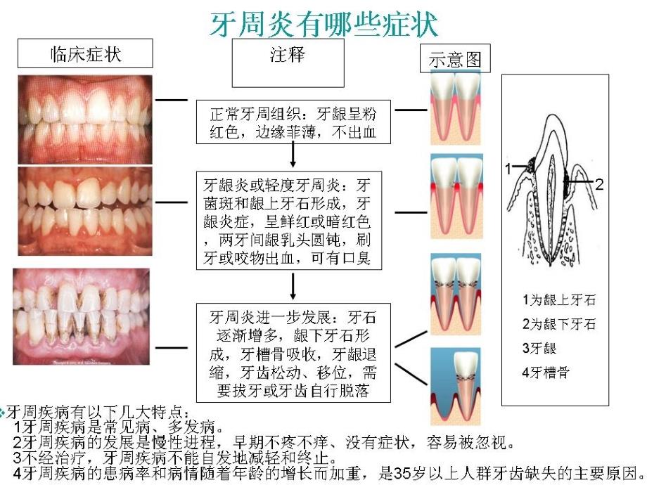 牙周炎的分类及临床表现_第2页