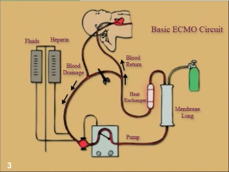 ECMO呼吸循环衰竭的应用文档资料_第3页