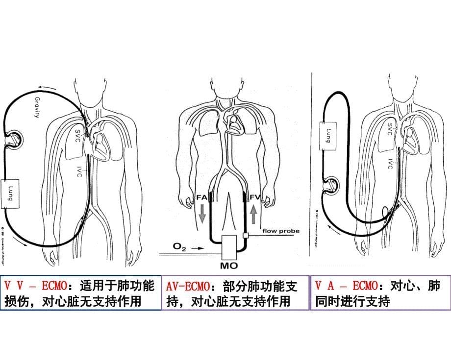 ECMO呼吸循环衰竭的应用文档资料_第5页