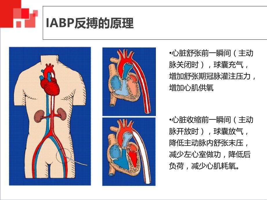 主动脉球囊反搏术IABP监测及护理_第5页