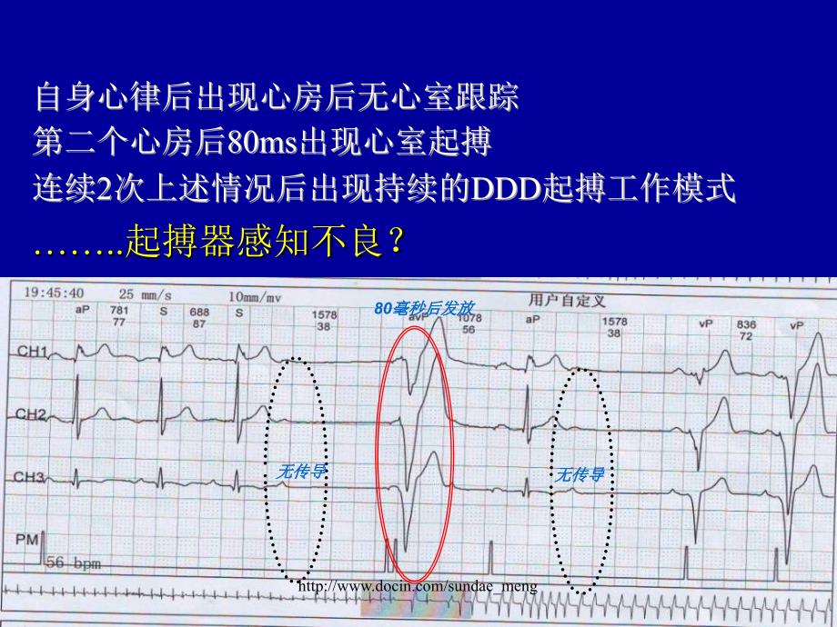 起搏器的特殊功能及心电图表现_第3页