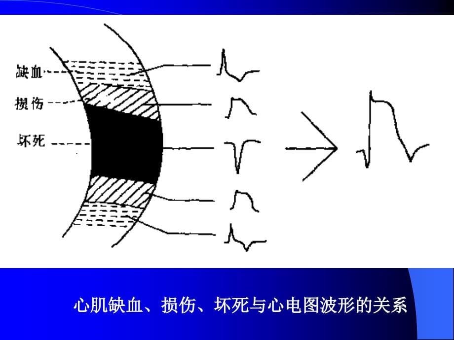 心肌梗死心电图-基层胸痛中心培训_第5页