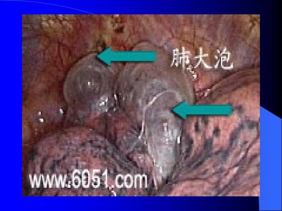 外科学教学课件：气胸_第5页