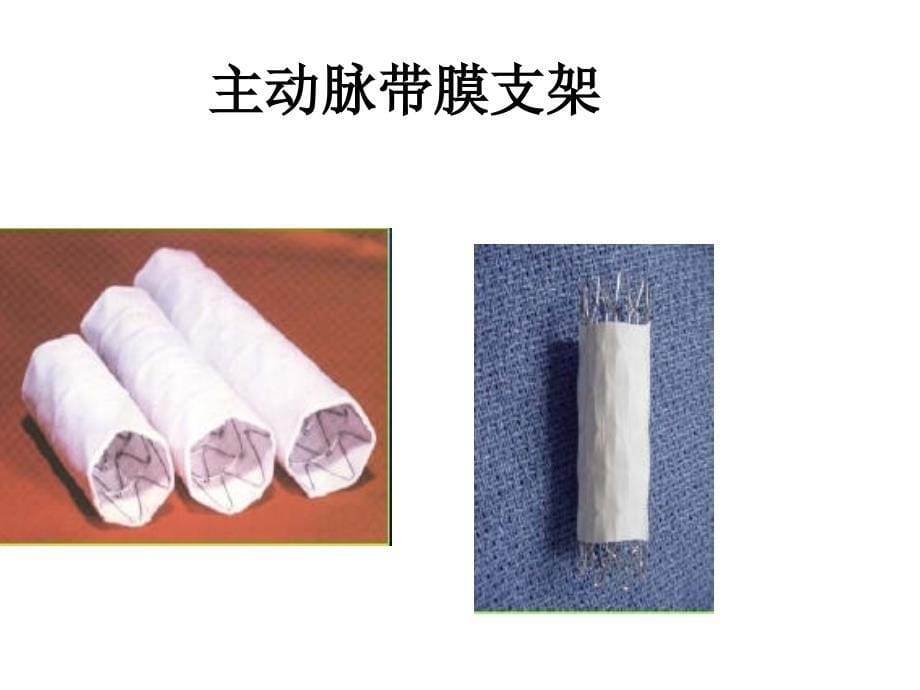 结构性脏病介入器械研制现状_第5页