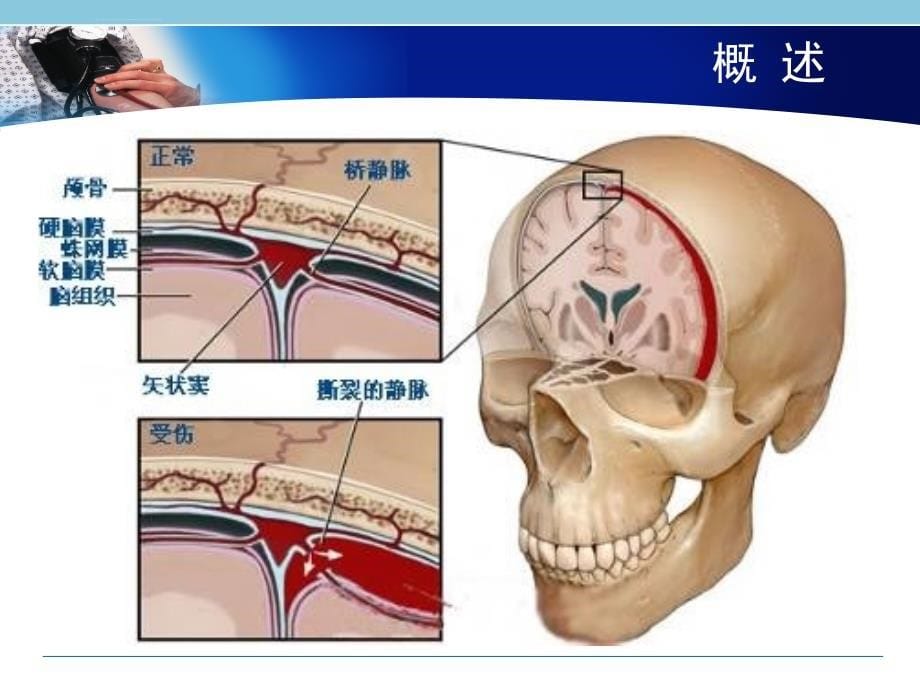 硬膜下血肿病人的护理ppt课件_第5页