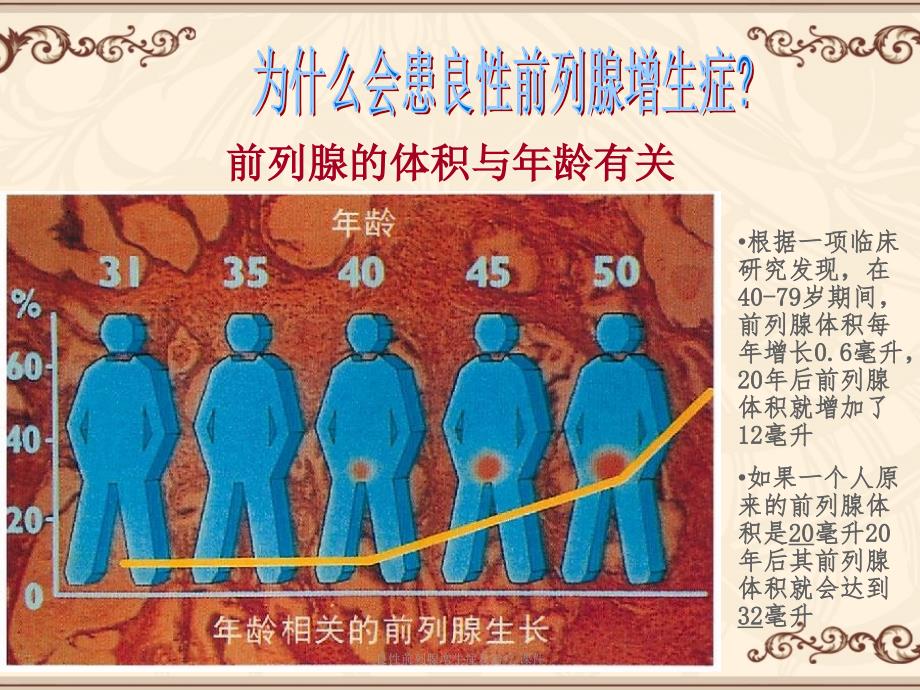 良性前列腺增生症及治疗课件_第4页