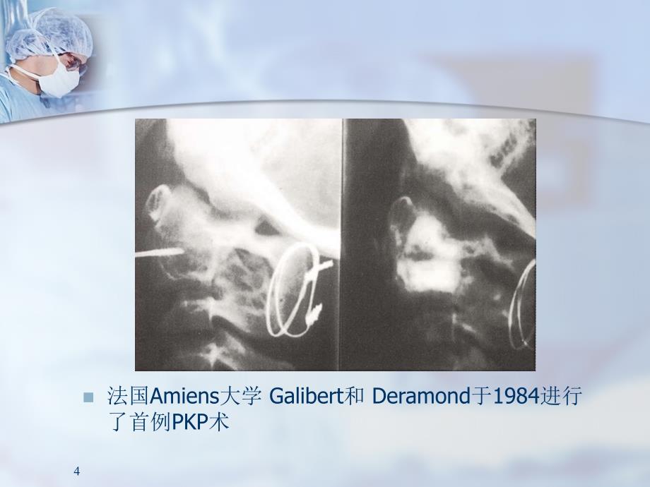 （优质课件）椎体后凸成形术-PKP手术技巧_第4页