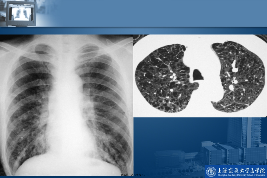2022医学课件呼吸系统影像学检查_第3页