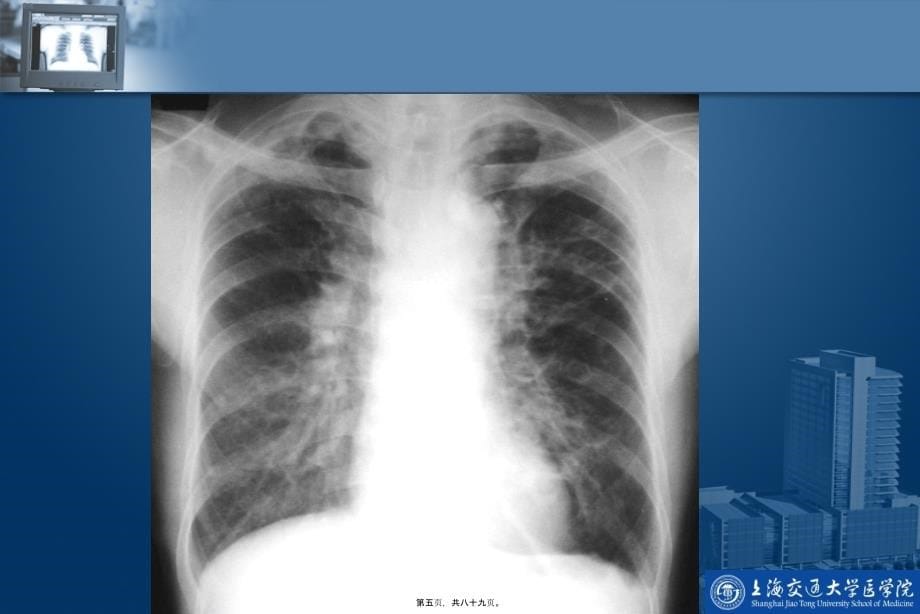 2022医学课件呼吸系统影像学检查_第5页