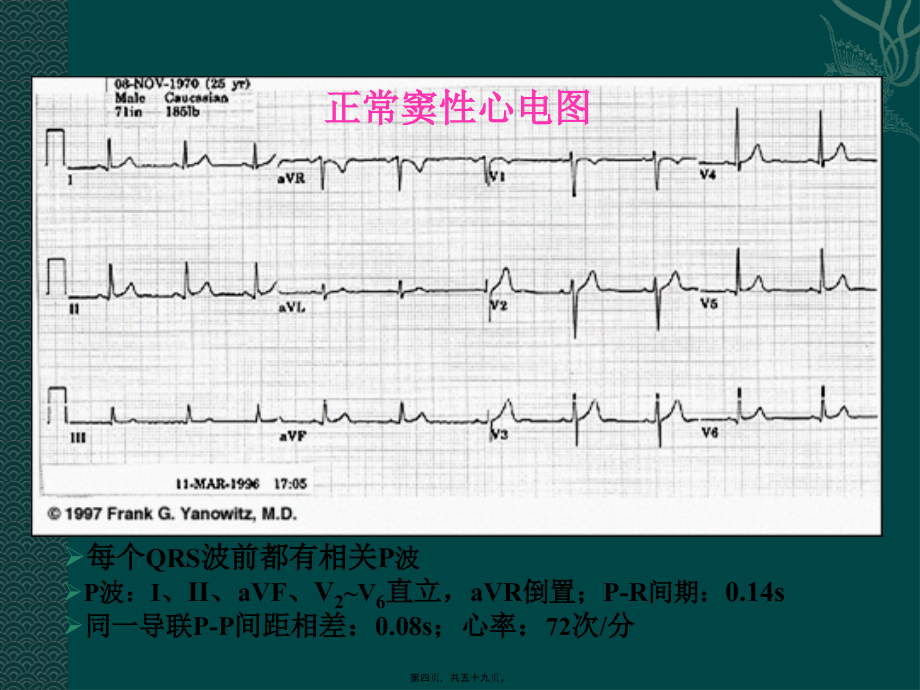 2022医学课件协和医科大学心电图详解_第4页