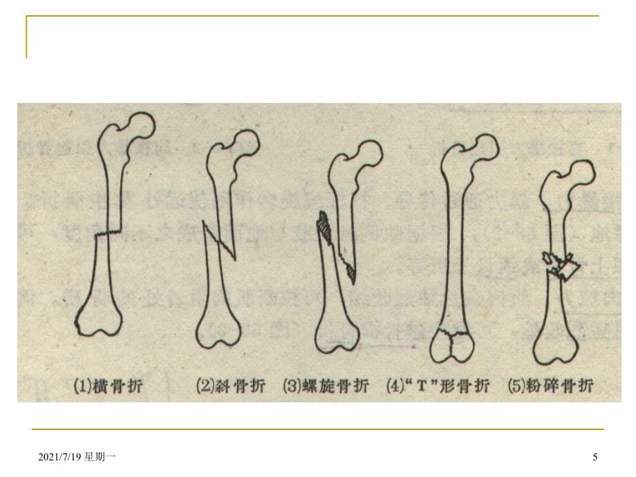 医学专题可出现前臂骨筋膜室综合征_第5页