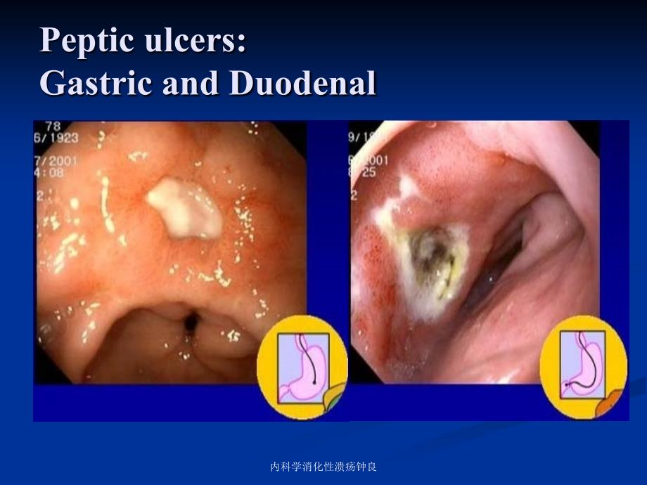 内科学消化性溃疡钟良课件_第3页