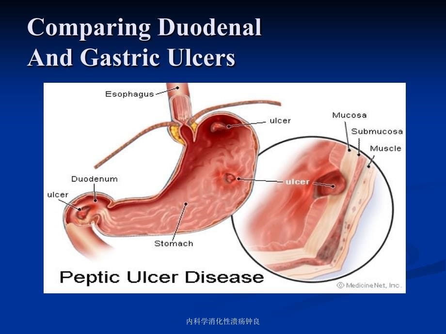 内科学消化性溃疡钟良课件_第5页