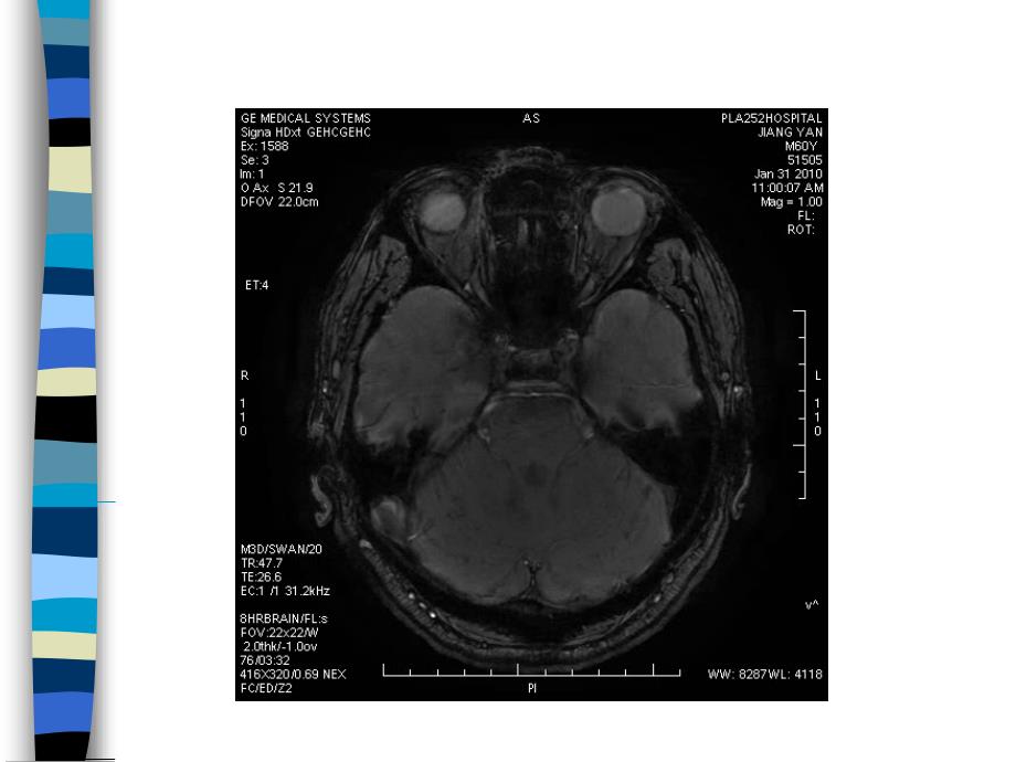 MR磁敏感加权成像在颅脑疾病中的应用.ppt_第3页