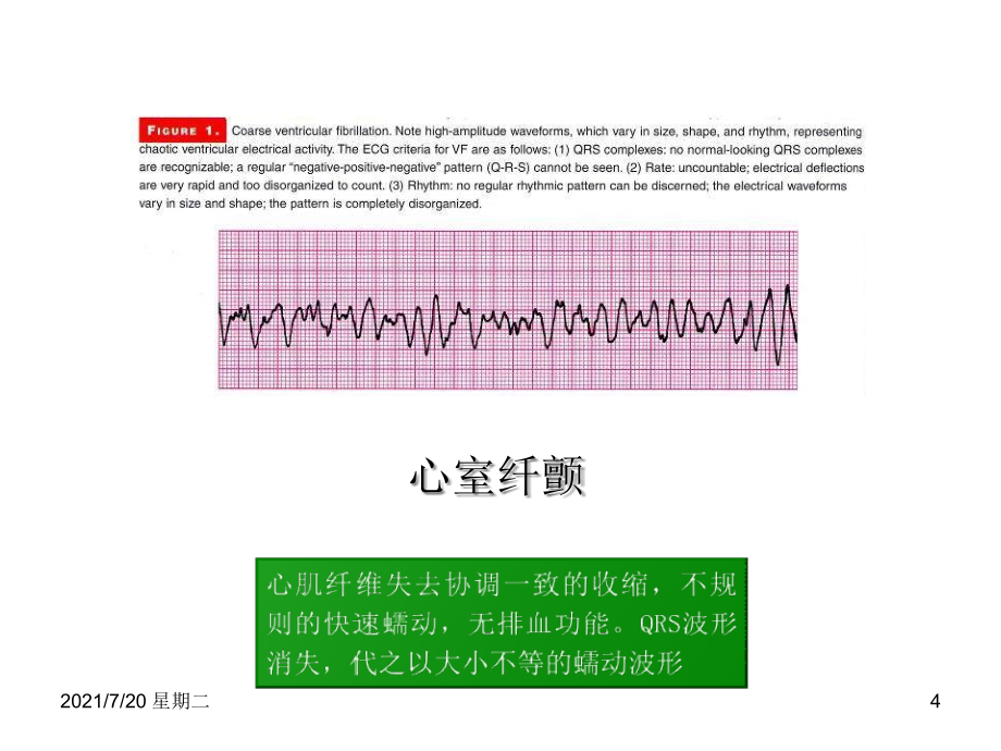 医学专题心肺脑复苏-心律失常_第4页