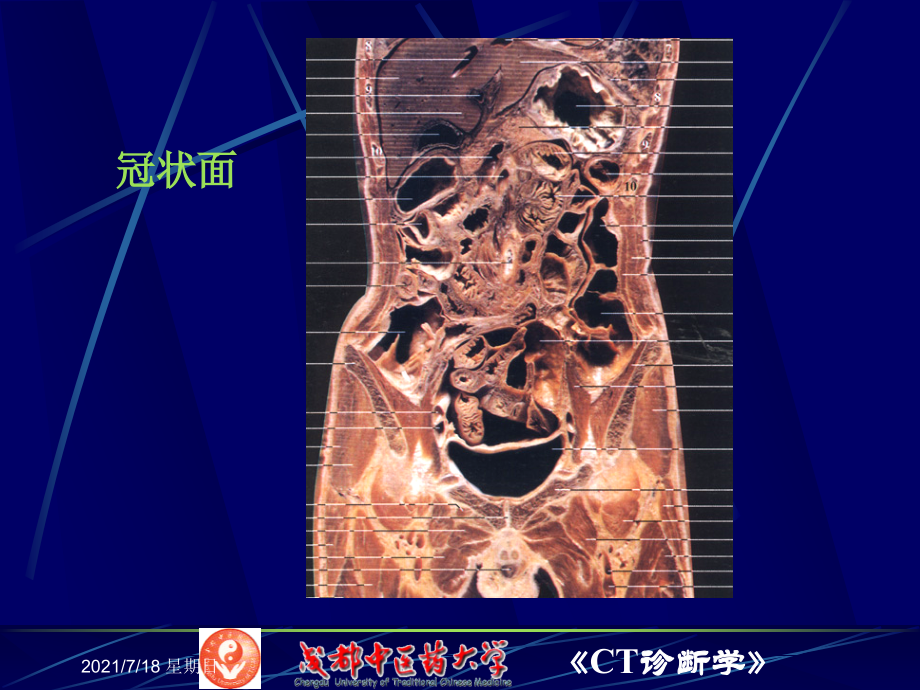 医学资料7腹膜腔、腹膜后CT检查_第4页