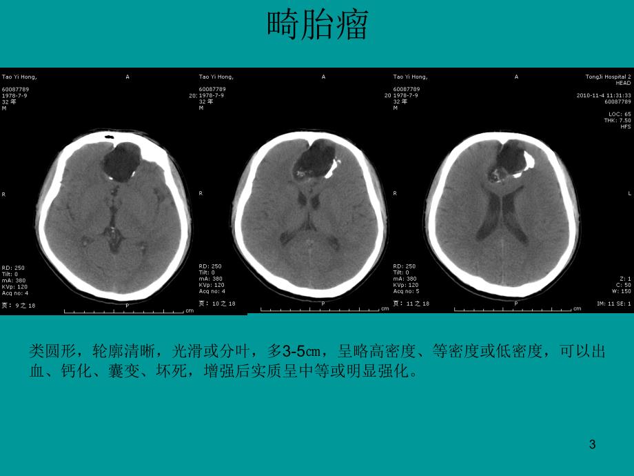 典型病例影像表现ppt课件_第3页