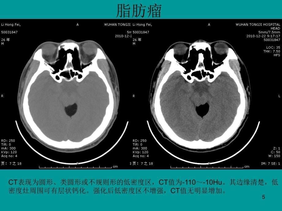 典型病例影像表现ppt课件_第5页