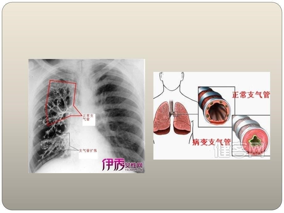 支气管扩张护理要ppt课件.ppt_第5页