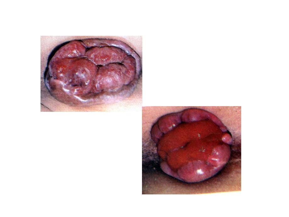 肛肠外科学课件：痔 (2)_第2页