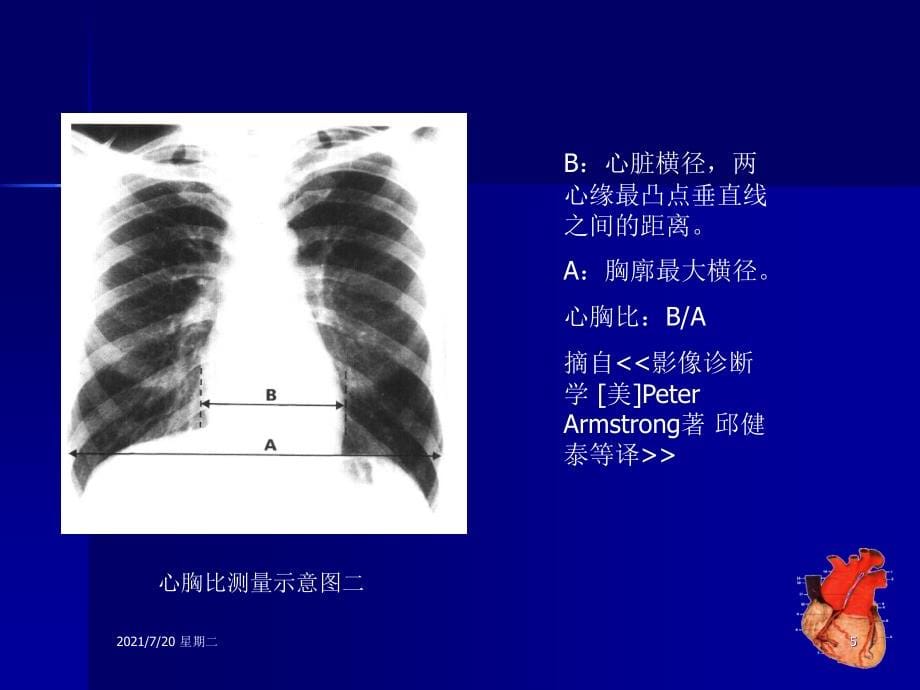 医学专题心脏胸片_第5页