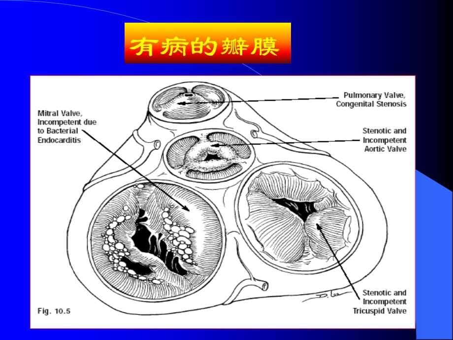 医学专题心脏瓣膜病-精品_第5页